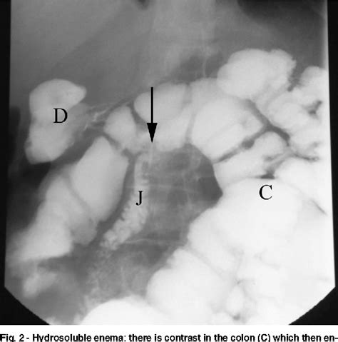 Figure 2 from Gastrojejunocolic fistula after gastric surgery for duodenal ulcer: case report ...