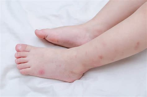 Why Are Mosquitoes Attracted to Our Feet and Ankles