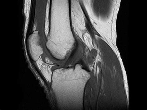 Knee Lesions on MRI Likely to Worsen Into OA