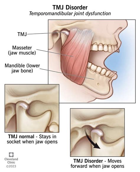 TMJ Disorders: Symptoms, Causes & Treatment