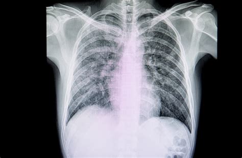 Film De Radiographie Pulmonaire D'un Patient Souffrant De Pneumonie Grave | Photo Premium