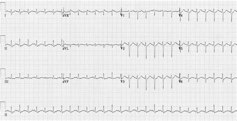 Sinus tachycardia • LITFL • ECG Library Diagnosis