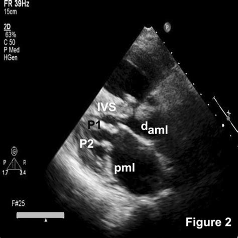 Parasternal long axis view demonstrating the papillary muscles (1 and ...