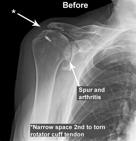 Partial or Total Shoulder Replacement | Dr Skedros Orthopaedics