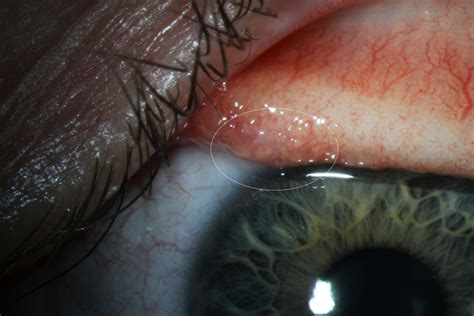 World first: Woman in North America infected with eye worm that only attacks cattle