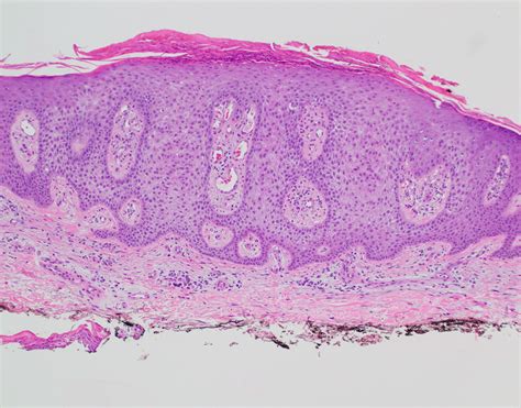 Clear cell acanthoma | Dermatopathology