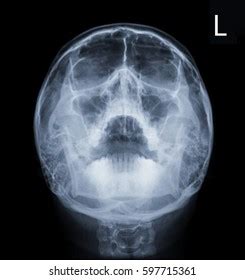 Film Xray Skull Pns Waters View库存照片597715361 | Shutterstock