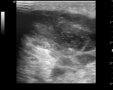 Axillary abscess | Image | Radiopaedia.org