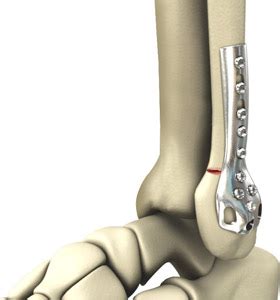 Lateral Malleolus Fracture