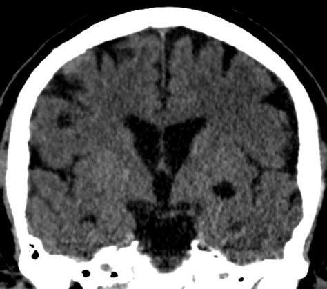 Choroidal fissure cyst - Alchetron, The Free Social Encyclopedia