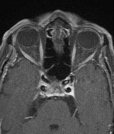 Optic nerve melanocytoma | Image | Radiopaedia.org