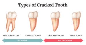 types-Cracked-tooth | Twinkle Family Dentalcare