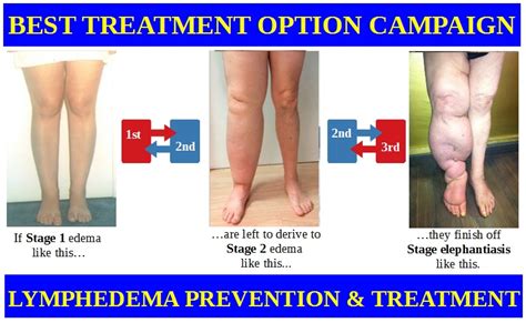 Asociación Galega de linfedema, lipedema, insuficiencia venosa crónica y otras patologías: WHY ...