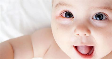 Infant Pink Eye: When To Seek Medical Attention: Pediatrician's Advice