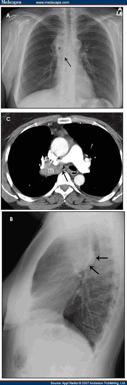 Imaging of the mediastinum in oncology