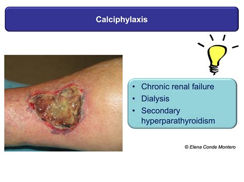 Necrosis and purple edges in leg ulcers: keys to guide your diagnosis