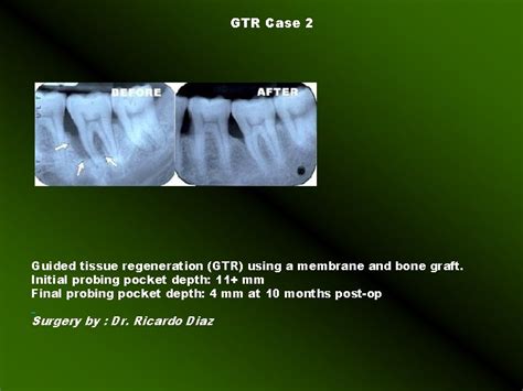 Guided Tissue regeneration and Guided Bone Regeneration Guided