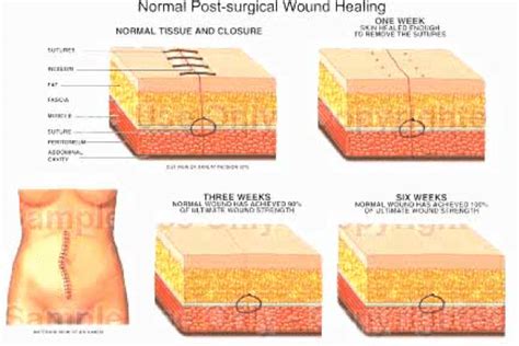 Acute Wounds - Advanced Oxygen Therapy Inc.