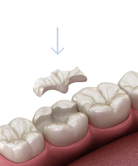 Overlays - Salisbury Villa Dental