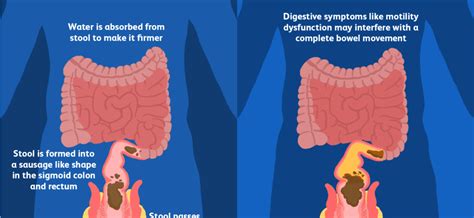 Defecation – the most common problems. How to take care of regular defecation? – Healthy Food ...