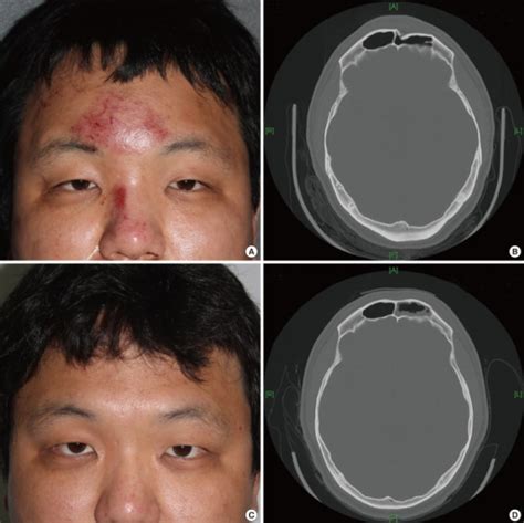 Case 1(A) Preoperative photograph shows the slight depr | Open-i