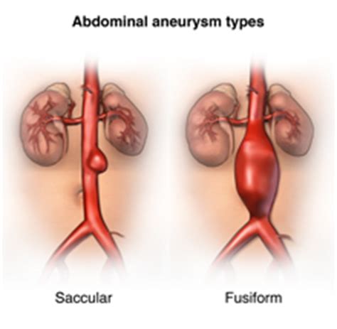 Abdominal Aortic Aneurysm - Health Encyclopedia - University of Rochester Medical Center