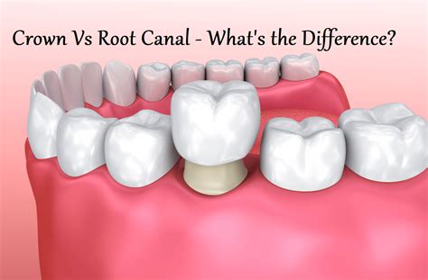 Crown Vs Root Canal - What's the Difference? | Learning Joan