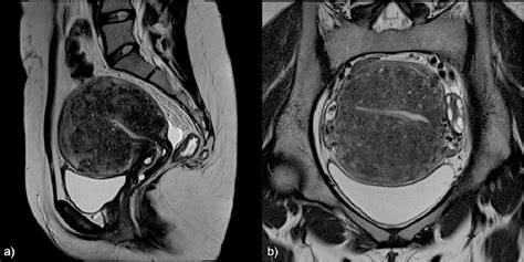 Adenomyosis and MRI: What you need to know and be aware of | Semantic ...