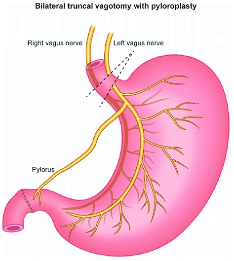 Vagotomy And Pyloroplasty