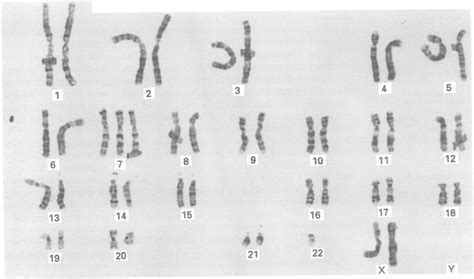 Karyotype of trisomy 7 seen in both chorionic villi and term placenta. | Download Scientific Diagram