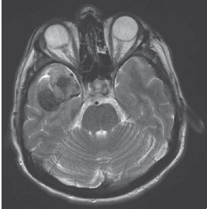 Brain T2-weighted MRI of dermoid cyst. | Download Scientific Diagram