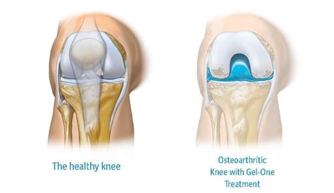 Knee Gel Injections