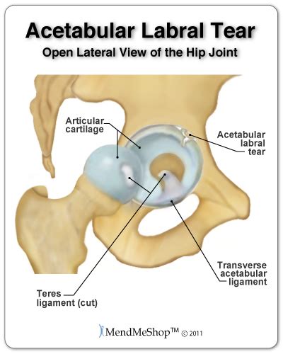 Acetabular Labral Tear - Hip Joint