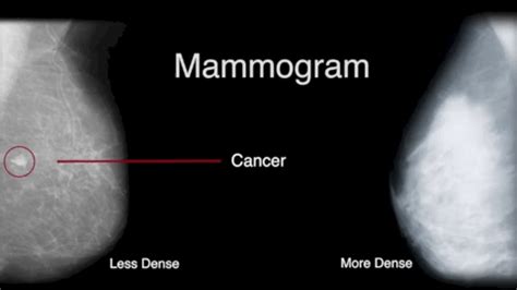 The Masking Effect of High Mammographic Breast Density (MBD) - Wellend ...