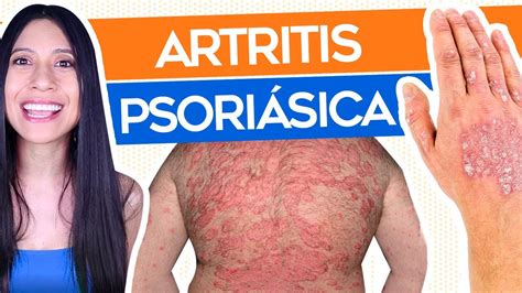 Artritis Psoriásica y Psoriasis: Guía completa - YouTube