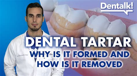 TARTAR from teeth - Causes, prevention and how to REMOVE dental PLAQUE ...