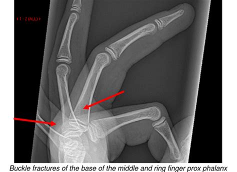 Hand and finger fractures