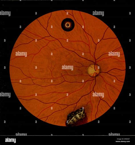 "Atlas and epitome of ophthalmoscopy and ophthalmoscopic diagnosis" (1910 Stock Photo - Alamy