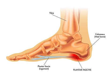 Bodywork Techniques for Plantar Fasciitis | Massage Professionals Update