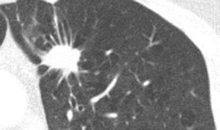 Can a Lung Nodule with Spiculations Be Benign? » Scary Symptoms