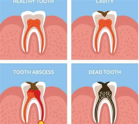 Why are root canals painful? - Dental News Network