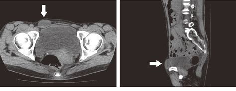 Figure 2 from A Case of Hydrocele of the Canal of Nuck in a Middle-aged Female | Semantic Scholar