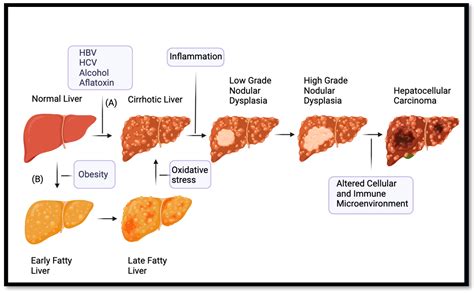 IJMS | Free Full-Text | Hepatocellular Carcinoma: Past and Present Challenges and Progress in ...