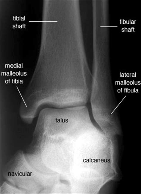 Radiographic Anatomy of the Skeleton: Ankle -- Mortise View, Labelled