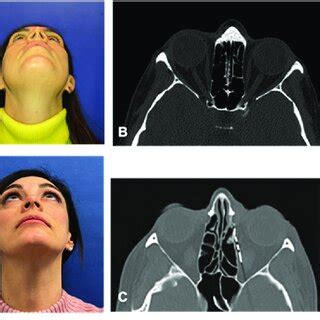 (A): Preoperative pictures showing left hypoglobus and enophthalmos ...