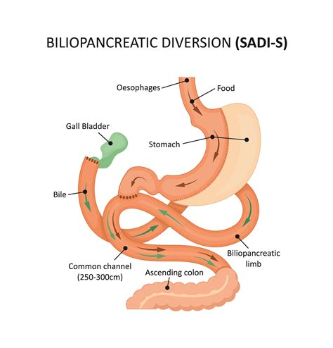 Modified Duodenal Switch | Bariatric Surgical Procedure