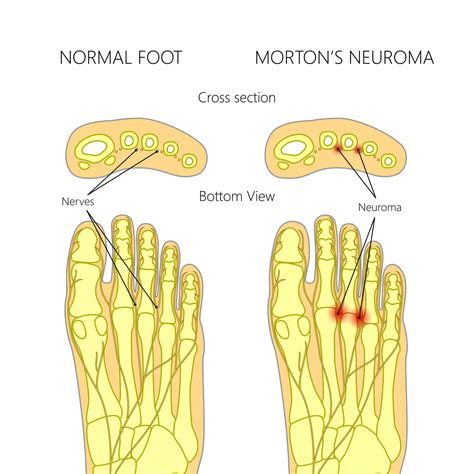 Pinched Nerve in Foot: the causes explained by a Foot Specialist