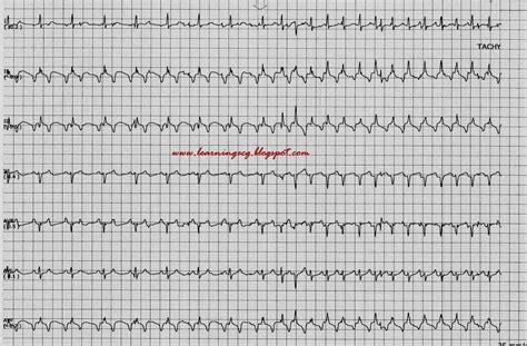 ECG Rhythms: A long RP tachycardia with alternating cycle length