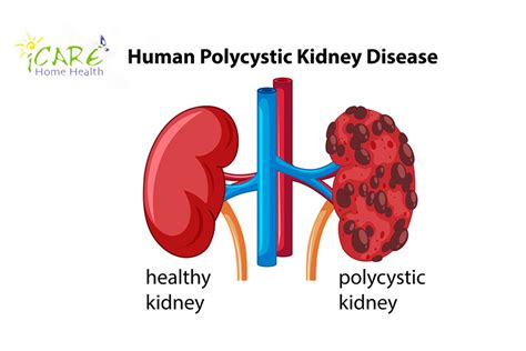 Polycystic Kidney Disease Awareness Day - iCare