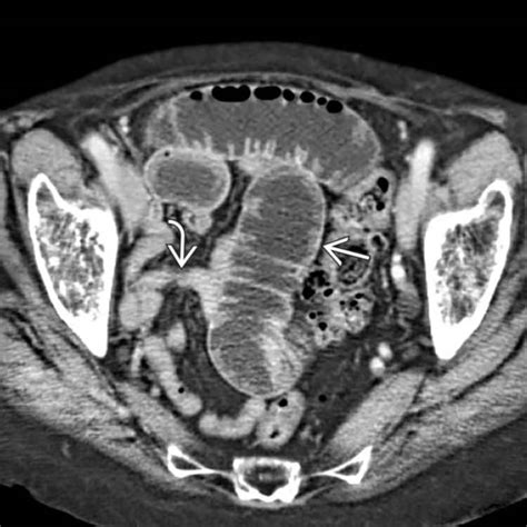 Obturator Hernia | Radiology Key